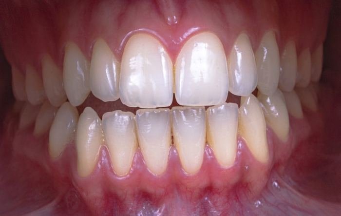 Close-up of crowded, overlapping front teeth