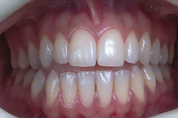 Close-up clinical view of a deep dental bite