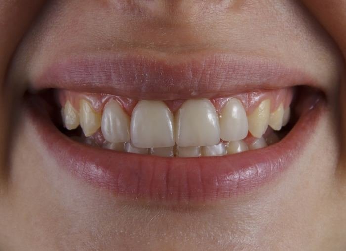Close-up clinical view of forwardly placed upper teeth