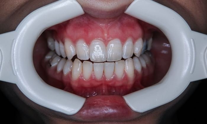 Dental exam with retractor showing an open bite