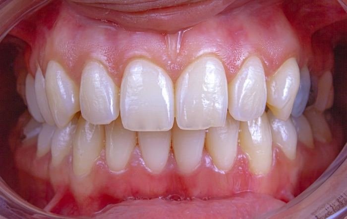 Close-up smile showing dental exam of tooth spacing
