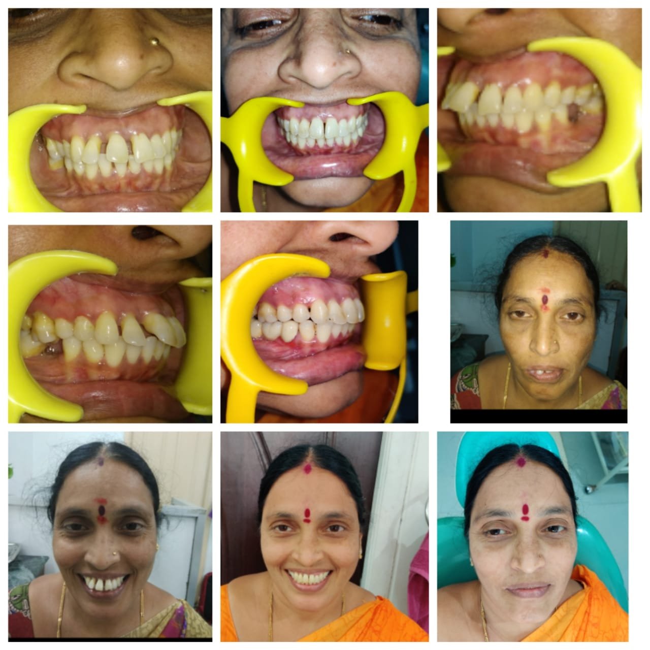 Dental Restoration Journey