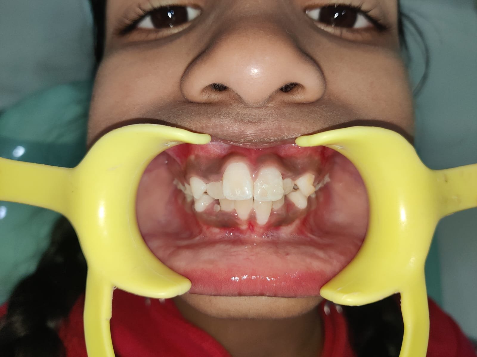 Crowded Teeth Assessment