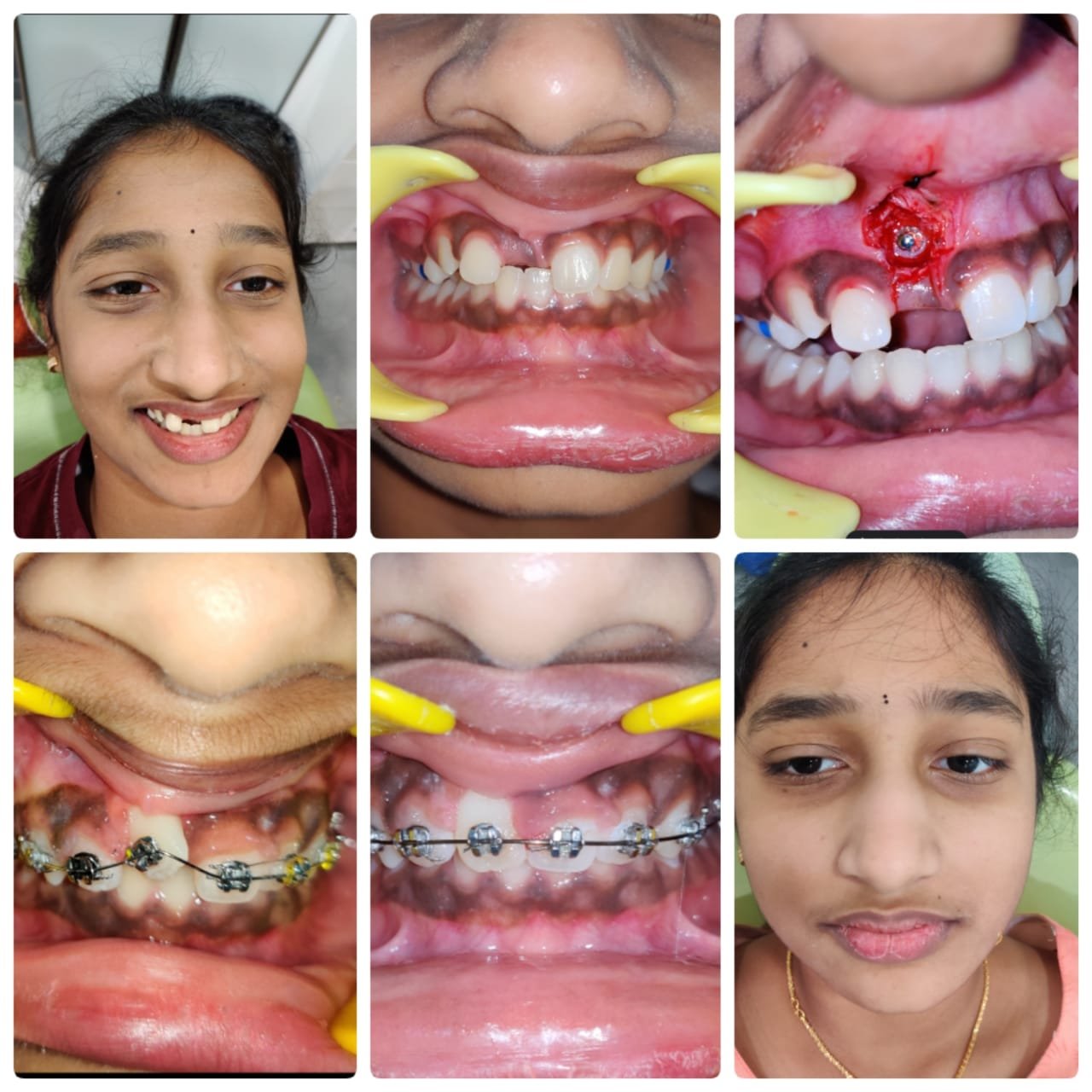 Orthodontic Braces Journey